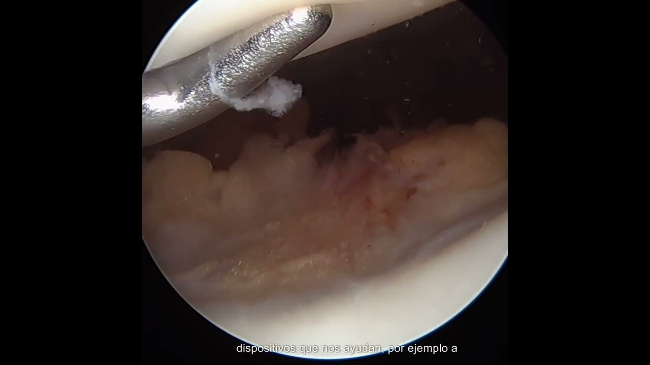 ¿Qué es la artroscopia de rodilla? ¿Cómo se realiza una artroscopia de rodilla?