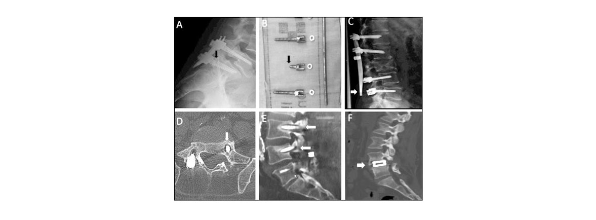 Artrodesis vertebral posterior