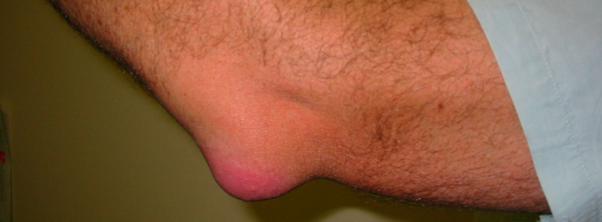 Bursitis