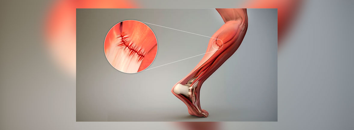 Desgarres Musculares