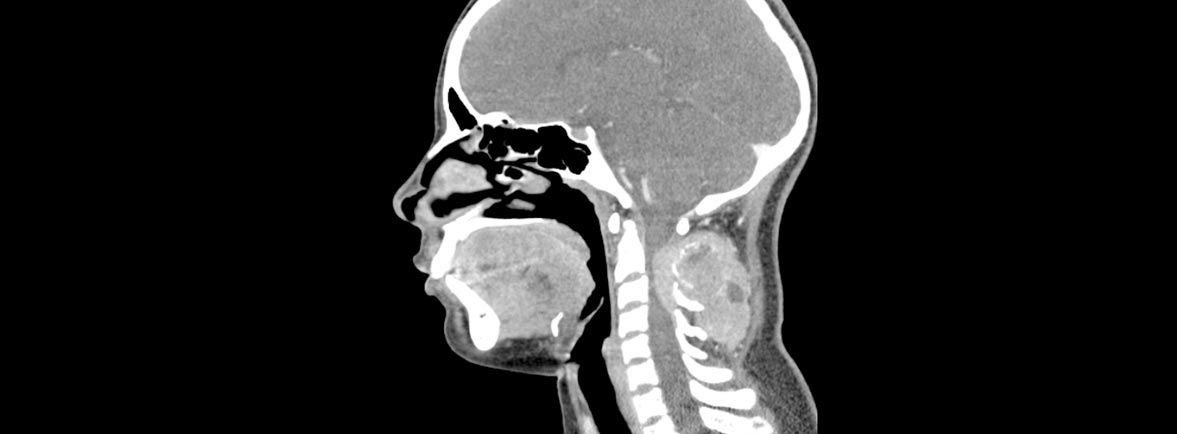 Sarcoma de Ewing