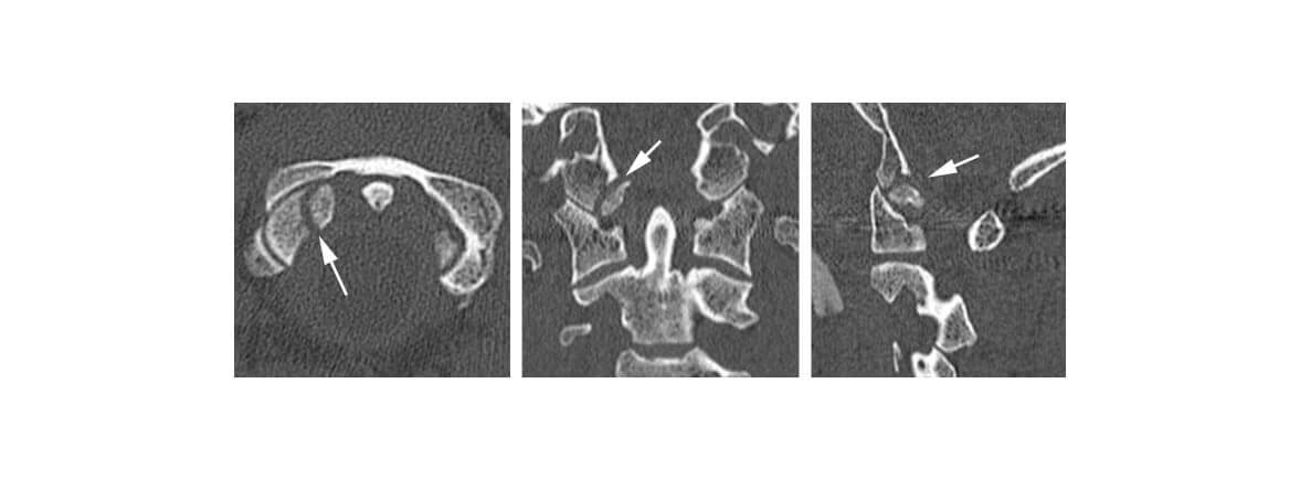Fractura de condilo occipital