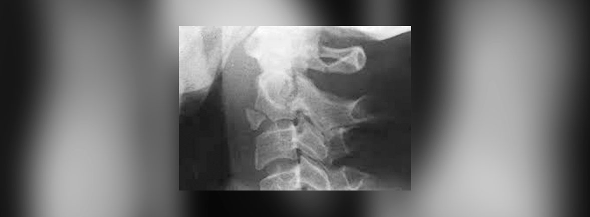 Fractura de axis - Las fracturas de la columna cervical superior pueden ir acompañadas de desplazamiento rotatorio o tortícolis. El dolor en la carga axial indica lesiones óseas y, si se encuentra en los niveles de la columna cervical superior, puede ser un indicador de fractura de axis (C2). Hay dolor asociado a la distribución del nervio occipital mayor y existe dolor de cabeza en dicha región. Fractura de axis