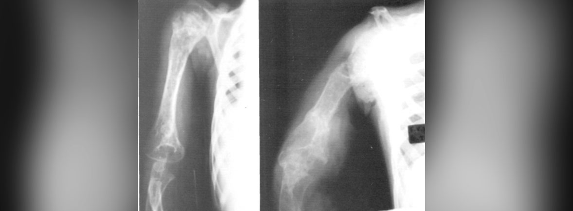 Angiomatosis quistica ósea - ANGIOMATOSIS QUISTICA ÓSEA Angiomatosis quistica ósea