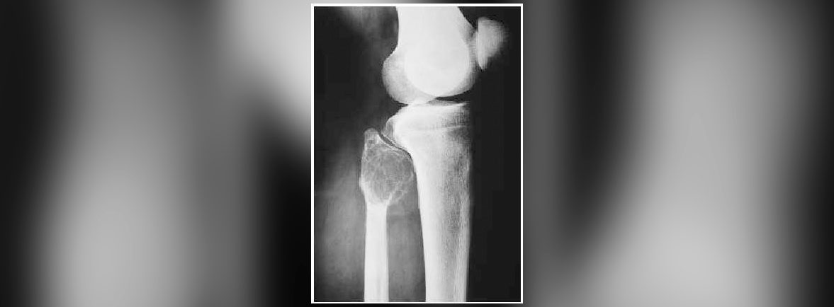 Tumores y pseudotumores de los huesos - Los tumores en la mano son poco frecuentes y los tumores malignos son particularmente raros (proporción 150:1); sin embargo, las lesiones pseudotumorales primarias de la mano, son muy frecuentes, pueden involucrar hueso, cartílago, tendones, vasos, nervios, tejido celular subcutáneo o piel. Tumores y pseudotumores de los huesos