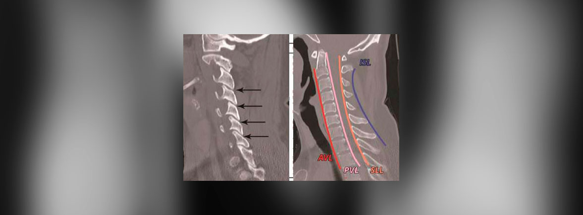 Trauma cervical subaxial - La columna cervical subaxial está compuesta de las vértebras C3 a C7. Los estudios epidemiológicos han demostrado que ocurren fracturas o dislocaciones de la columna cervical en 2-3% de los pacientes con traumatismos; sin embargo, las lesiones de la columna cervical subaxial representan el 65% de todas las fracturas de la columna cervical y más del 75% de las dislocaciones, siendo C6 el vértebra subaxial fracturada más común y C5 a C6 siendo el nivel dislocado más común. Históricamente, ha existido un debate sobre la clasificación y el tratamiento adecuados de las lesiones de la columna cervical subaxial. Existe poca evidencia de la mejor forma de tratamiento para las lesiones subaxiales; sin embargo, los sistemas de clasificación y tratamiento basados en evidencia más recientes han acercado a una forma más sistemática. Trauma cervical subaxial