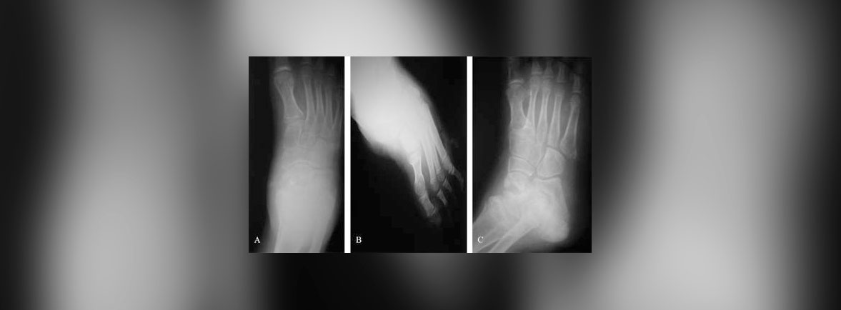 Analgesia congenita y fracturas - ANALGESIA CONGENITA Y FRACTURAS Analgesia congenita y fracturas