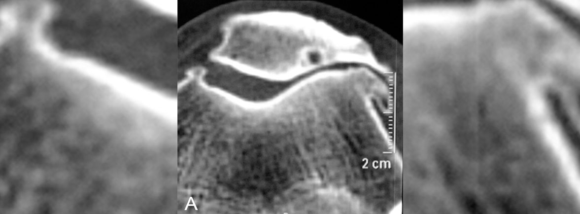 Artrosis patelofemoral - ARTROSIS PATELOFEMORAL Artrosis patelofemoral
