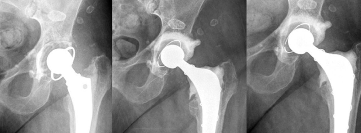 Infección periprotésica - La infección de la articulación periprotésica (IAP) es un tipo específico de infección relacionada con el reemplazo de la articulación y una complicación terrible, potencialmente crónica, con relevancia clínica significativa para el paciente afectado, el cirujano tratante y el sistema de salud. Infección periprotésica