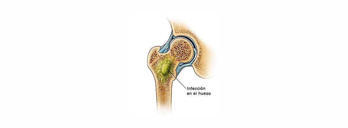 Osteomielitis hematogena - La incidencia de osteomielitis varía geográficamente. Como se resume en una revisión sistemática la incidencia varió de aproximadamente 1 en 5000 a 7700 niños en países desarrollados y 1 en 500 a 2300 niños en países en desarrollo. La osteomielitis hematógena es más común en niños que en adultos. Los niños se ven afectados casi el doble que las niñas. Más de la mitad de los casos pediátricos ocurren en niños menores de cinco años y una cuarta parte en niños menores de dos años. Sin embargo, la osteomielitis es poco frecuente en lactantes pequeños (<4 meses) sin factores de riesgo subyacentes. Osteomielitis hematogena