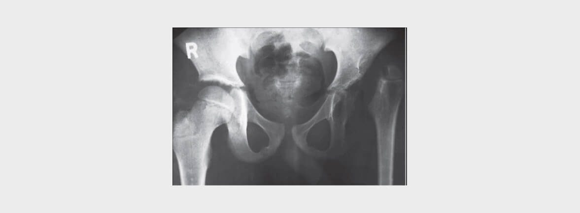 Artritis séptica - Ningún síntoma es específico de artritis séptica. Estos se presentan generalmente en un periodo comprendido entre 1 y 2 semanas, sin embargo algunos factores como la presencia de organismos de baja virulencia, infección por Mycobaterias o prótesis pueden retrasar la presentación. Los principales síntomas sondolor articular constante (85%); inflamación (78%); la fiebre (57%), escalofríos (27%) y enrojecimiento o rigidez articular (27%). La inflamación episódica se da en la sífilis, enfermedad de Lyme y la artritis reactiva posterior a infecciones entéricas y Chlamydia. La inflamación poliartricular ocurre como una reacción inmunológica durante la endocarditis, fiebre reumática, hepatitis B aguda e infección diseminada por Neisseria. Las infecciones por bacterias y virus usualmente afectan múltiples articulaciones. Artritis séptica