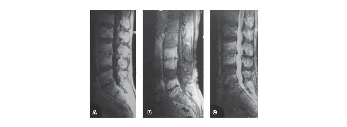 BRUCELLOSIS Y LUMBALGIA (DOLOR EN ZONA LUMBAR DE COLUMNA)