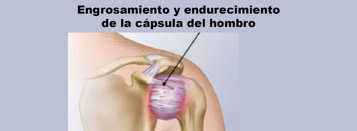 Capsulitis adhesiva, Hombro congelado