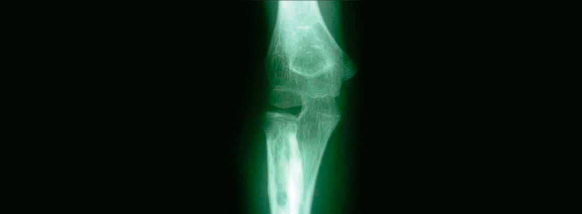 Enfermedad de caffey - Denominada hiperostosis cortical infantil, enfermedad de Caffey-Silverman, hiperostosis cortical infantil familiar o hiperostosis cortical infantil esporádica. Fue descrita en 1930 por Roske, por Ellis en 1938 y finalmente por Caffey y Silverman en 1945. Es una enfermedad rara en lactantes y niños pequeños. La etiología es desconocida pero se conoce la existencia de dos formas: familiar de trasmisión autosómica dominante con penetrancia variable (con afectación más frecuentemente en tibias) y esporádica (que normalmente siempre afecta a la mandíbula). Enfermedad de caffey
