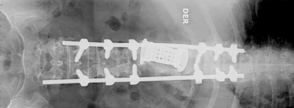 Hidatidosis vertebral - La hidatidosis causada por el Echinococcus granulosus y puede afectar cualquier órgano del cuerpo siendo el pulmón y el hígado los más comúnmente afectados. Posee un método de transmisión fecal-oral; el contacto con perros y ovejas son factores de riesgo conocidos. La mayoría de los casos ocurre en sectores rurales. Después de la ingesta de material contaminado, el embrión es absorbido en la pared intestinal; llega al torrente sanguíneo desde donde alcanza rápidamente hígado y pulmón. Hidatidosis vertebral
