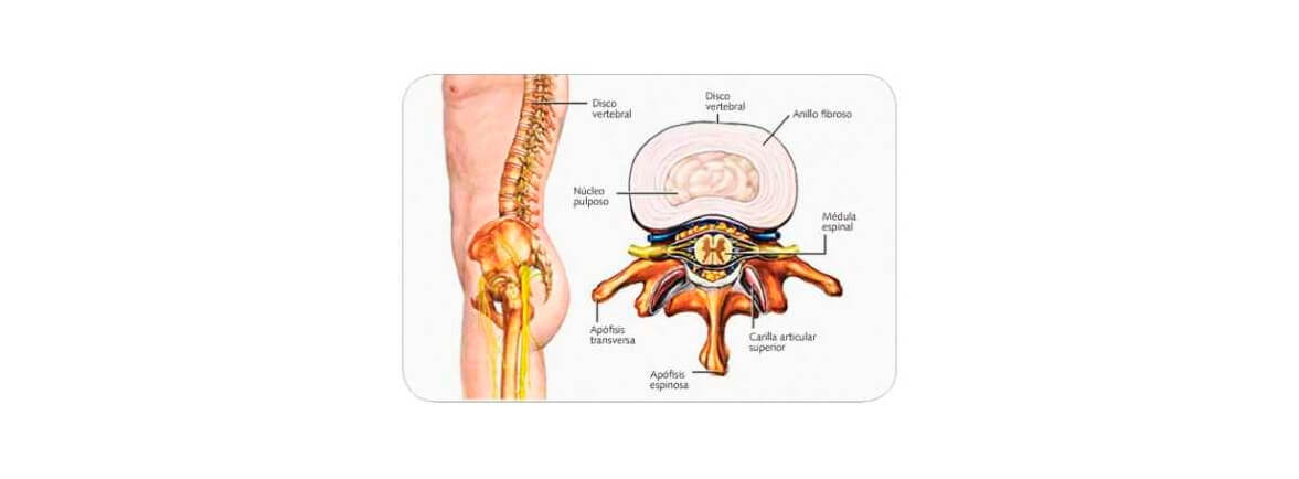 Hernia de disco lumbar - North American Spine Society, 2011, Hernia de disco lumbar, USA, https://www.spine.org/Portals/0/Assets/Downloads/KnowYourBack/HerniatedLumbarSpanish.pdf Hernia de disco lumbar