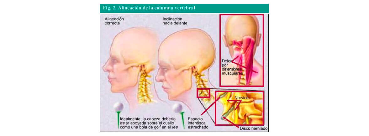 Lesión de músculos de cuello por trabajo - Lesión de músculos de cuello por trabajo. Lesión de músculos de cuello por trabajo