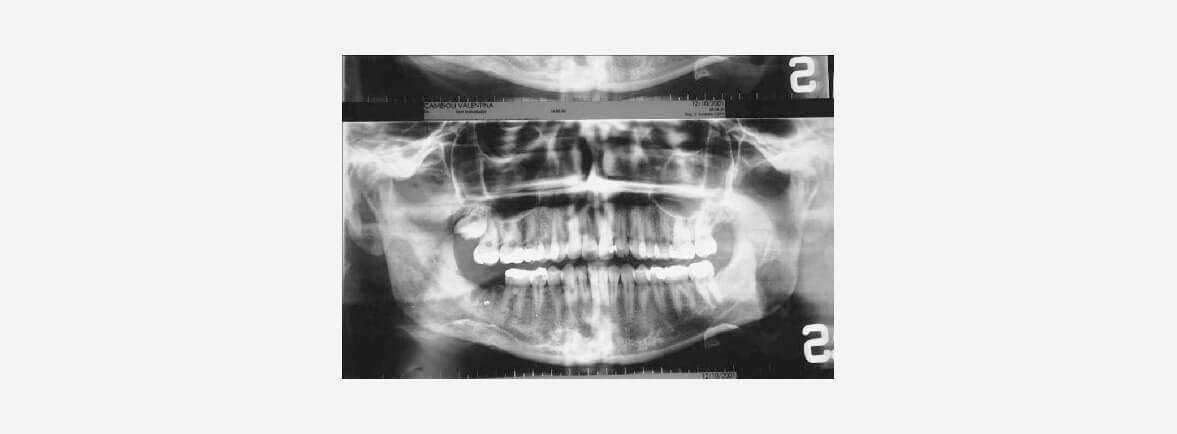 Osteomielitis esclerosante de garré - Las características clínicas del síndrome de Garre generalmente están representadas por una asimetría facial sostenida por una hinchazón dura mandibular unilateral localizada. Esto se puede ver tanto en el examen extraoral como en el intraoral. La piel suprayacente parece normal y la membrana mucosa se caracteriza por un desarrollo rápido y una regresión espontánea con remodelación, pero la historia clínica puede presentar parámetros variables. El dolor puede ser episódico con períodos inactivos, y la inflamación progresiva puede ser el único síntoma. Puede aparecer trismo (rigidez y cierre firme de la boca por espasmo) y se puede observar linfadenopatía. Osteomielitis esclerosante de garré