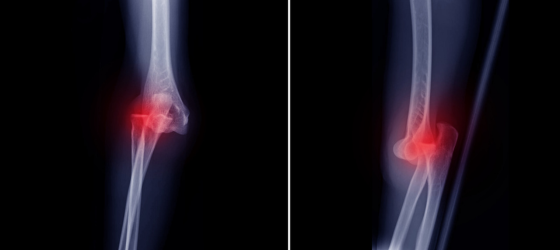 Luxación Traumática: El Tipo Más Grave de Lesión de Rodilla