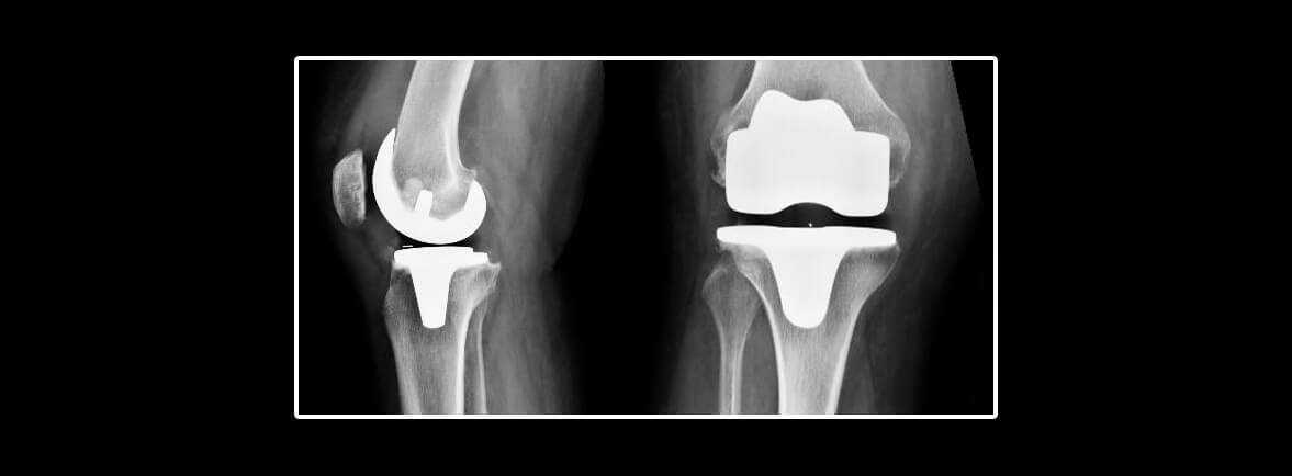 Complicaciones tromboembólicas y hemorrágicas después de una artroplastia total de rodilla primaria: Un estudio de cohorte nacional danés