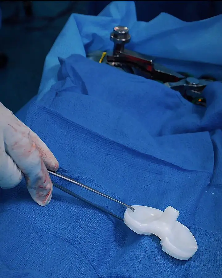 Inserto de polietileno de alta resistencia de una prótesis de rodilla sostenido con pinza durante la cirugía