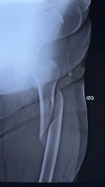 Fractura de fémur en el adulto mayor: atender a tiempo cambia la recuperación - Dr. Esteban Castro - Médico Traumatólogo Ortopédista | Cirugía de columna y articular