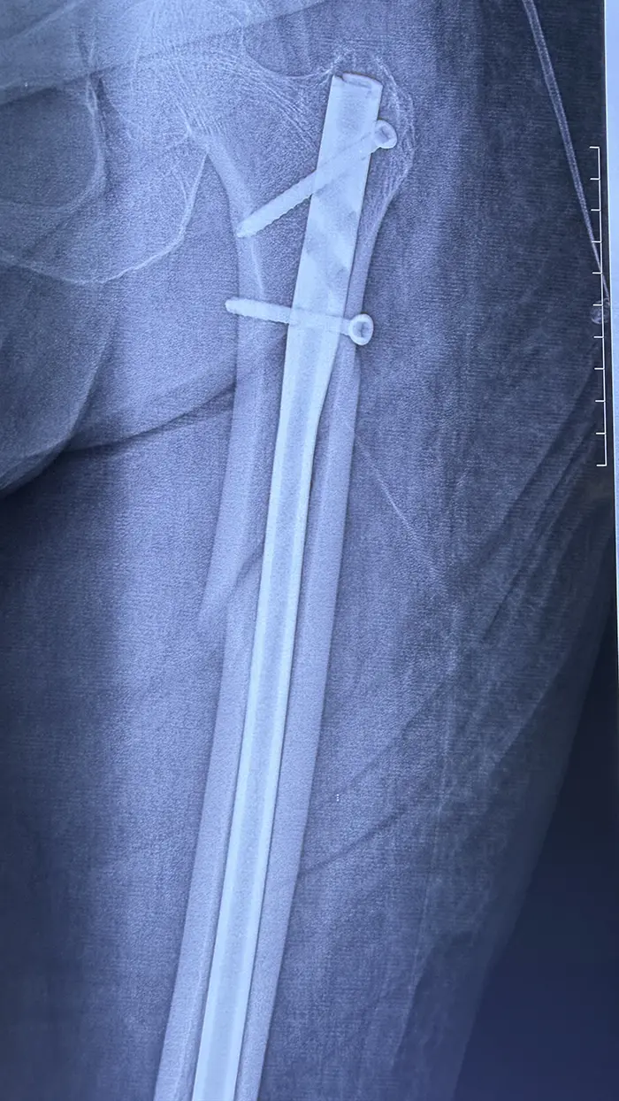 Fractura de fémur en el adulto mayor: atender a tiempo cambia la recuperación - Dr. Esteban Castro - Médico Traumatólogo Ortopédista | Cirugía de columna y articular
