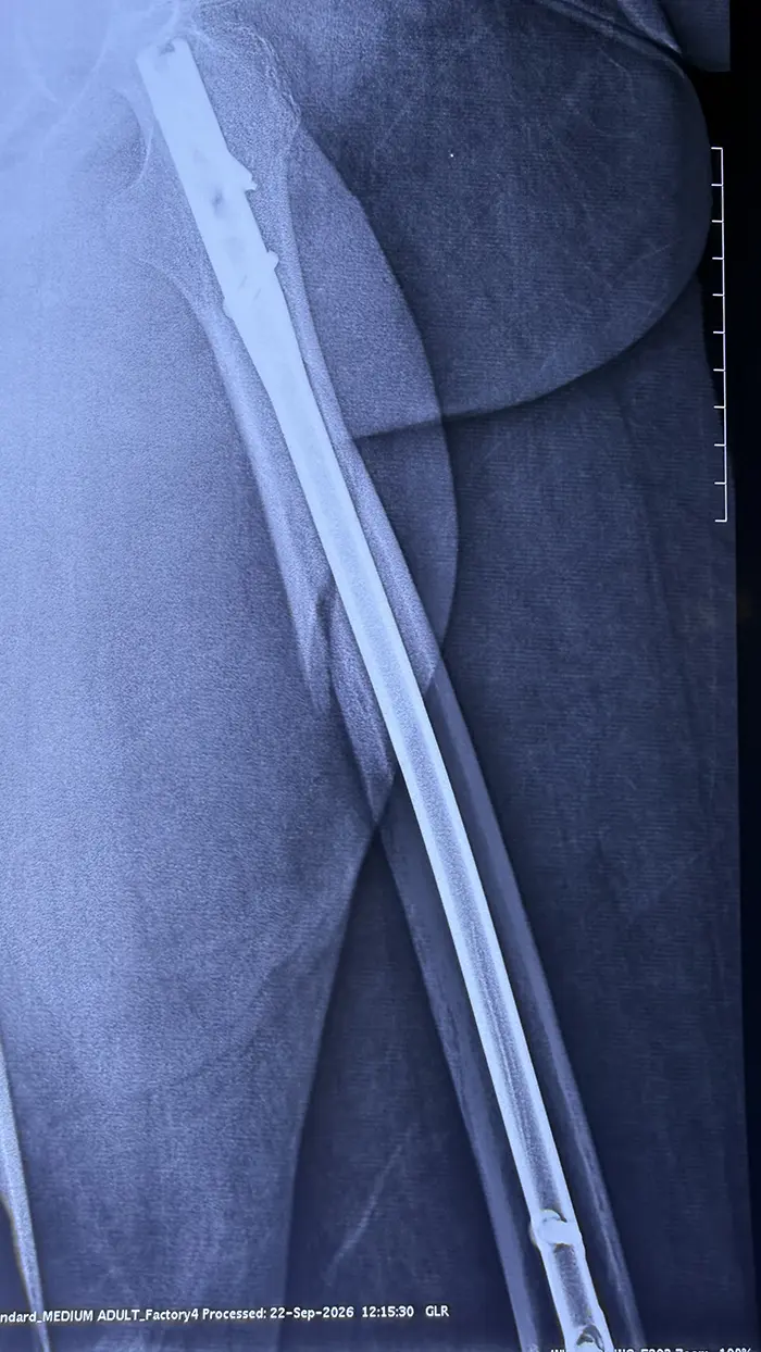 Fractura de fémur en el adulto mayor: atender a tiempo cambia la recuperación - Dr. Esteban Castro - Médico Traumatólogo Ortopédista | Cirugía de columna y articular